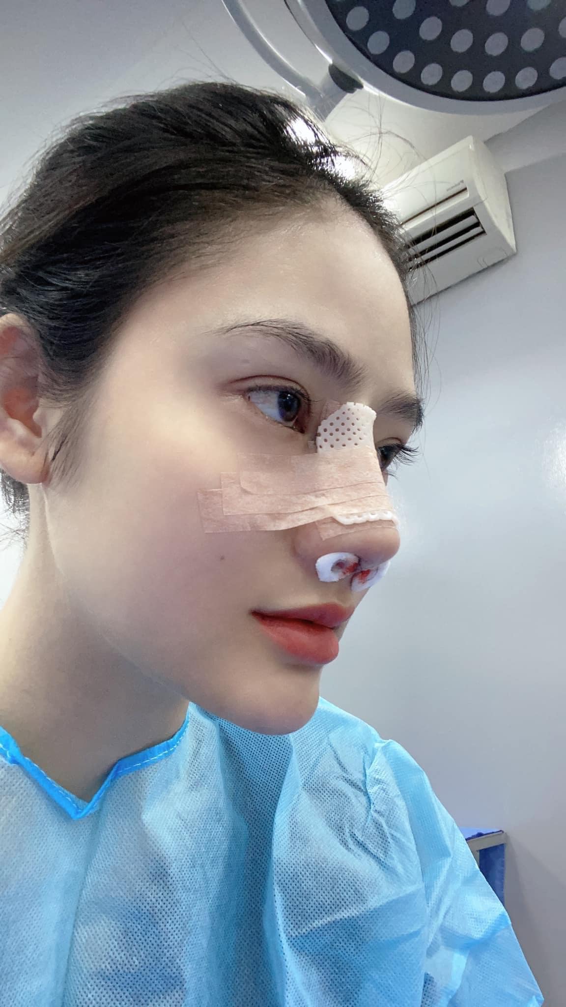 Sưng nề sau nâng mũi kéo dài bao lâu?