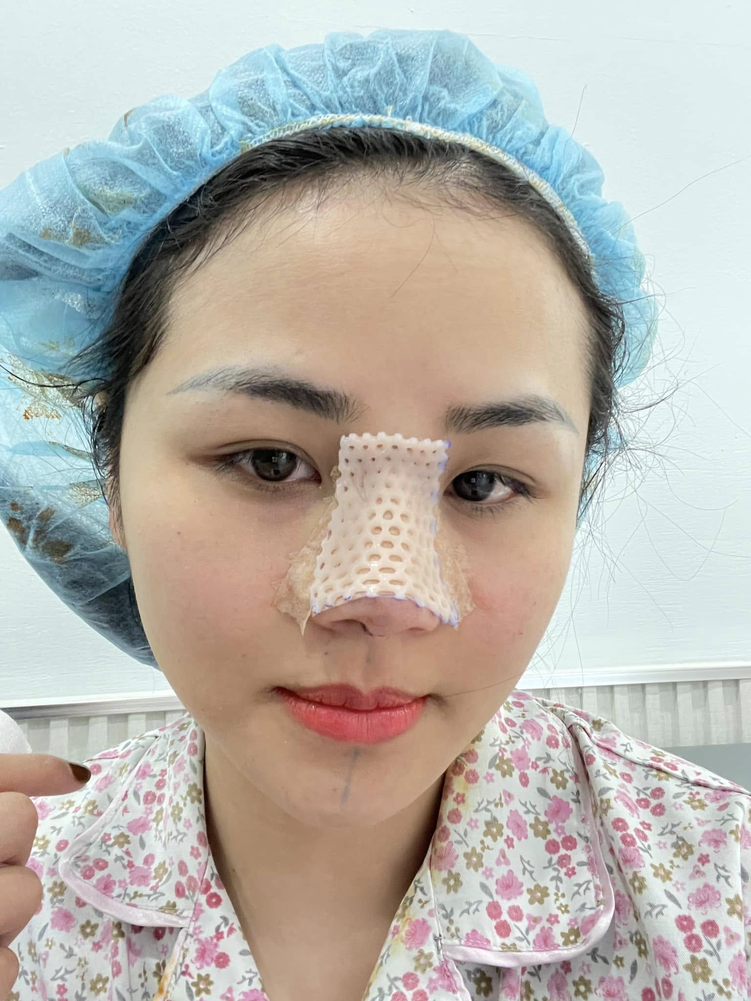 Yếu tố quan trọng để có dáng mũi tự nhiên – Kiểm tra kiến thức nâng mũi