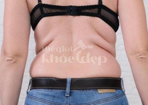 Hút Mỡ Lưng An Toàn & Hiệu Quả – Đấu Giá Dịch Vụ Giá Tốt tại thegioikhoedep.com