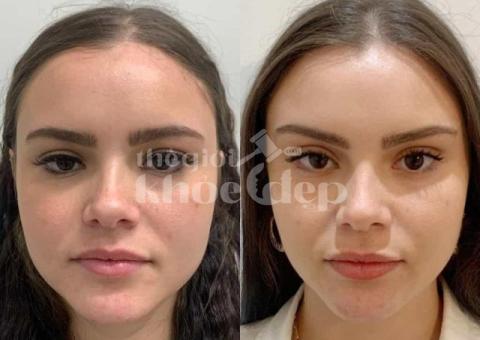 Căng chỉ nâng cơ cho phụ nữ sau sinh – Giải pháp trẻ hóa an toàn, hiệu quả