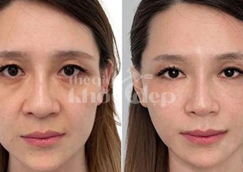 Căng chỉ nâng cơ tuổi 40 – Bí quyết trẻ hóa an toàn, hiệu quả