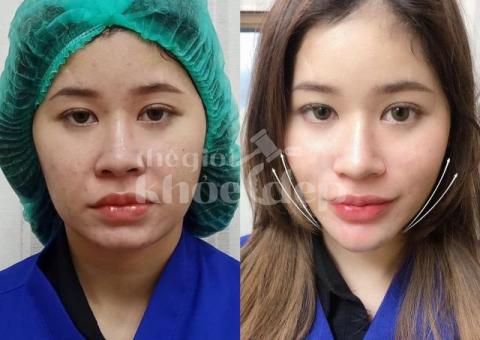 Căng chỉ V-line – Giải pháp tạo gương mặt thon gọn không dao kéo