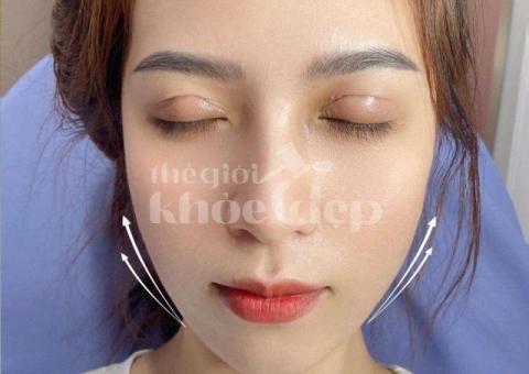 Căng chỉ nâng cơ sau giảm cân – Khắc phục da chảy xệ hiệu quả