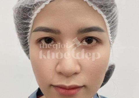 Căng chỉ nâng cơ sau giảm cân – Khắc phục da chảy xệ hiệu quả - 2/2