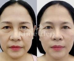Căng chỉ nâng cơ tuổi 30+ – Chặn đứng lão hóa, giữ mãi nét thanh xuân