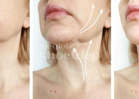 Căng chỉ nâng cơ vùng cổ – Giải pháp xóa nhăn, trẻ hóa toàn diện