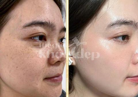 Trị Nám Hiệu Quả – Bí Quyết Phục Hồi Làn Da Sáng Mịn Tại Spa Uy Tín - 3/8