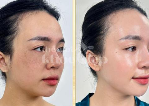 Trị Nám Hiệu Quả – Bí Quyết Phục Hồi Làn Da Sáng Mịn Tại Spa Uy Tín - 4/8