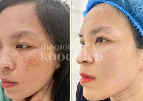 Trị Nám Hiệu Quả – Bí Quyết Phục Hồi Làn Da Sáng Mịn Tại Spa Uy Tín - 5/8