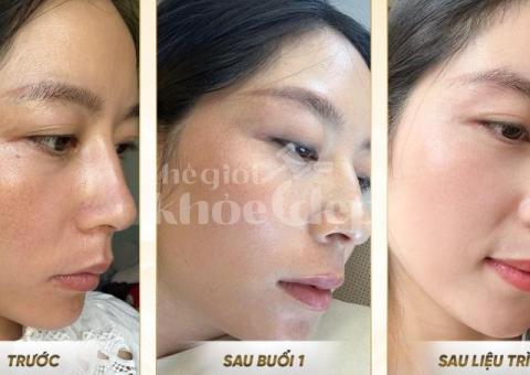 Trị Nám Hiệu Quả – Bí Quyết Phục Hồi Làn Da Sáng Mịn Tại Spa Uy Tín - 6/8