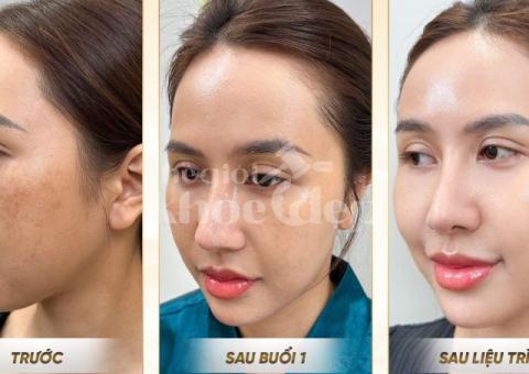 Trị Nám Hiệu Quả – Bí Quyết Phục Hồi Làn Da Sáng Mịn Tại Spa Uy Tín - 7/8