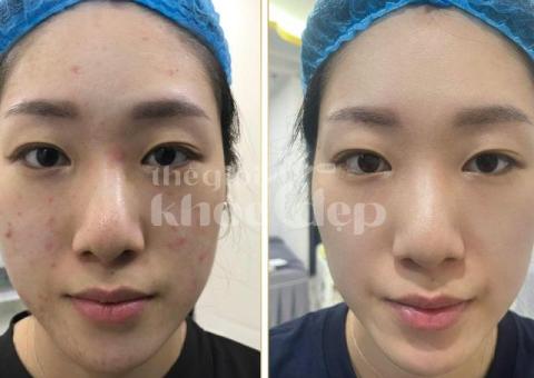 “Trán Không Còn Mụn – Da Mịn Sáng, Tự Tin Giao Tiếp!” - 4/8