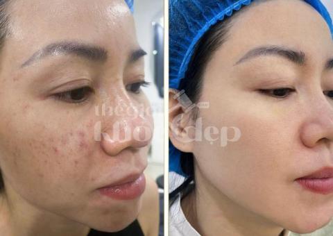 “Trán Không Còn Mụn – Da Mịn Sáng, Tự Tin Giao Tiếp!” - 5/8