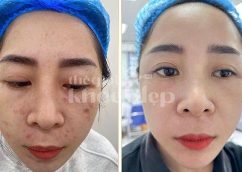 “Trán Không Còn Mụn – Da Mịn Sáng, Tự Tin Giao Tiếp!” - 8/8