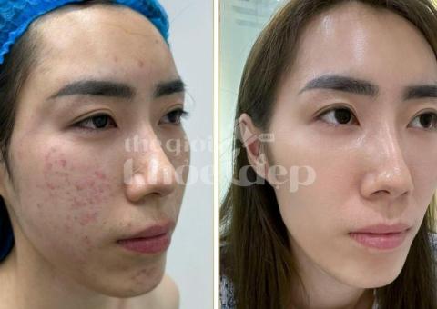 “Tuổi Dậy Thì Không Còn Ám Ảnh Vì Mụn – Bí Quyết Da Đẹp Ngay Từ Đầu!” - 3/3