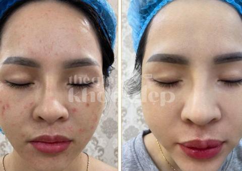 “Giải Pháp Vàng Cho Mụn Nội Tiết – Hết Sưng Viêm, Da Trở Lại Khỏe Đẹp!” - 3/3