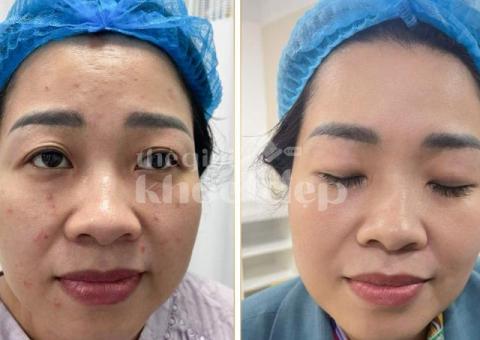 “Da Láng Mịn, Không Còn Lợn Cợn Mụn Ẩn – Bí Quyết Từ Chuyên Gia!” - 1/3