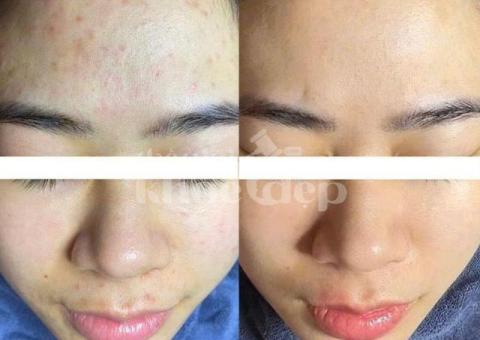 “Mụn Viêm, Mụn Mủ Không Còn Làm Bạn Đau Đớn & Mất Tự Tin!” - 3/3