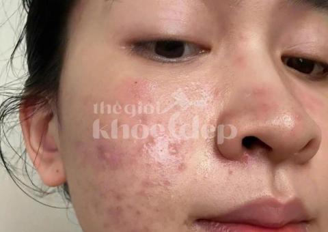 “Tạm Biệt Mụn Đầu Đen – Da Sáng Láng, Không Lỗ Chân Lông To!” - 1/3