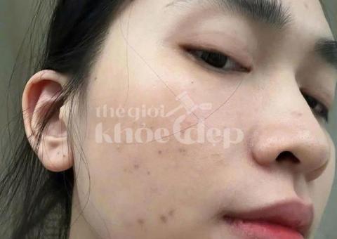 “Tạm Biệt Mụn Đầu Đen – Da Sáng Láng, Không Lỗ Chân Lông To!” - 2/3