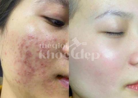 “Mụn Không Còn Là Nỗi Lo – Làn Da Sạch Sáng Chỉ Sau 1 Liệu Trình!” - 1/3