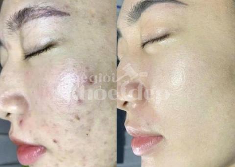 “Mụn Không Còn Là Nỗi Lo – Làn Da Sạch Sáng Chỉ Sau 1 Liệu Trình!” - 3/3