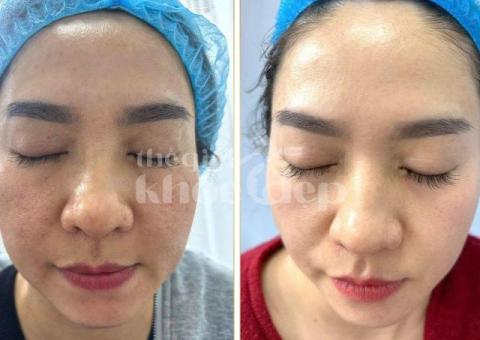 Trị lỗ chân lông to hiệu quả 2025 | Công nghệ y khoa – Da mịn màng, căng bóng - 1/3