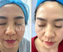 Trị lỗ chân lông to hiệu quả 2025 | Công nghệ y khoa – Da mịn màng, căng bóng