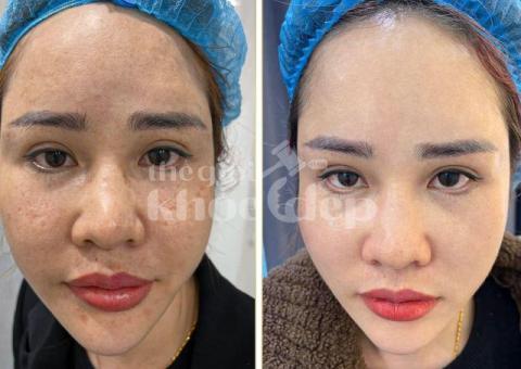 Trị lỗ chân lông to hiệu quả 2025 | Công nghệ y khoa – Da mịn màng, căng bóng - 2/3