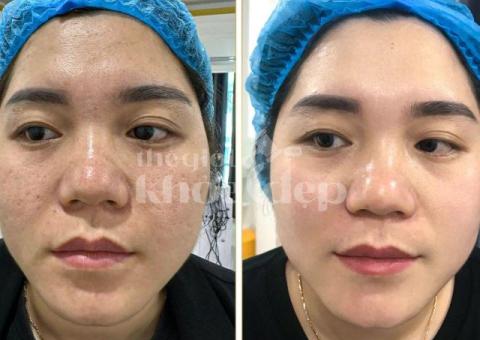 Trị lỗ chân lông to hiệu quả 2025 | Công nghệ y khoa – Da mịn màng, căng bóng - 3/3