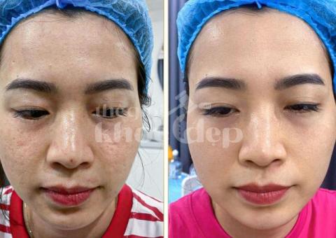 Trị sẹo rỗ nhanh chóng | Laser RF vi điểm – Da mịn săn chắc - 1/3