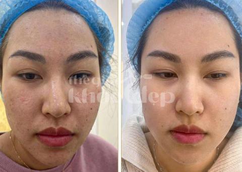 Trị sẹo rỗ nhanh chóng | Laser RF vi điểm – Da mịn săn chắc - 2/3