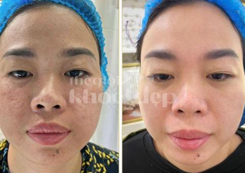 Trị sẹo rỗ nhanh chóng | Laser RF vi điểm – Da mịn săn chắc - 3/3