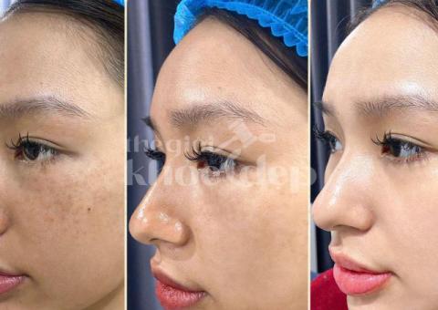 Trị Nám Peel Da Y Khoa – Làm Mờ Nám, Tái Tạo Làn Da Sáng Khỏe - 1/3