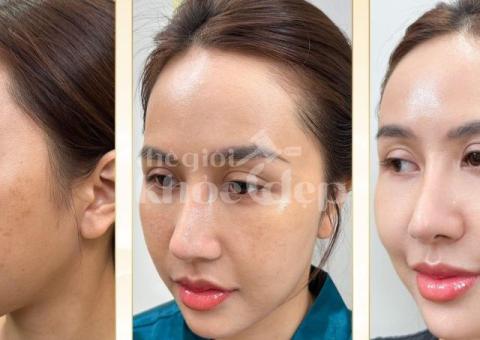 Trị Nám Peel Da Y Khoa – Làm Mờ Nám, Tái Tạo Làn Da Sáng Khỏe - 2/3