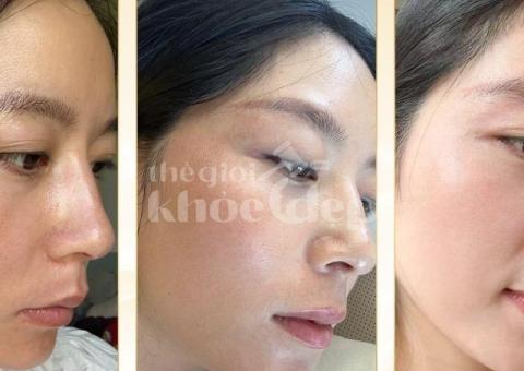 Trị Nám Peel Da Y Khoa – Làm Mờ Nám, Tái Tạo Làn Da Sáng Khỏe - 3/3