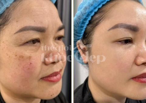 Trị Nám Do Nội Tiết – Cân Bằng Hormone, Da Sáng Mịn Tự Nhiên - 3/3