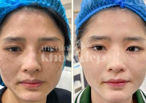 Trị Nám Bằng IPL – Công Nghệ Ánh Sáng Xung Hiện Đại, Hiệu Quả An Toàn - 1/3