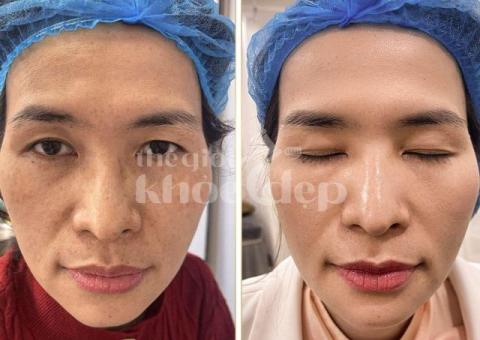 Trị Nám Bằng IPL – Công Nghệ Ánh Sáng Xung Hiện Đại, Hiệu Quả An Toàn - 3/3
