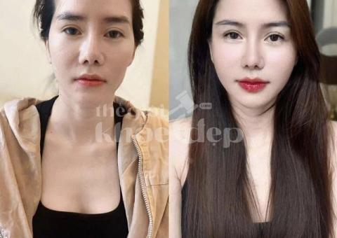 Tiêm Filler Tạo Hình Môi – Giải Pháp Sở Hữu Bờ Môi Căng Mọng, Quyến Rũ - 2/2