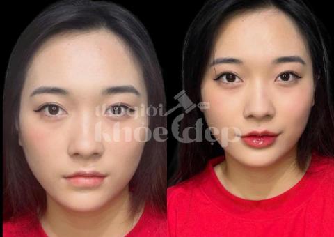 Tiêm Filler Nâng Mũi – Giải Pháp An Toàn, Không Phẫu Thuật, Hiệu Quả Tức Thì