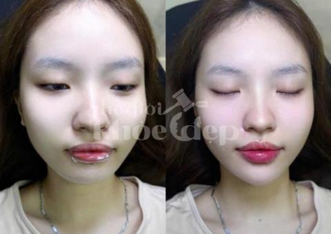 Cấy HA Collagen tạo hình môi căng mọng, quyến rũ, an toàn chuẩn y khoa