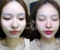 Cấy HA Collagen tạo hình môi căng mọng, quyến rũ, an toàn chuẩn y khoa