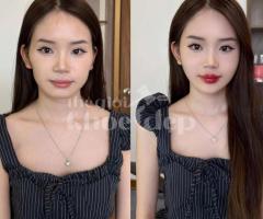 Cấy HA Collagen Tạo Hình Môi – Giải Pháp Cho Môi Căng Mọng Tự Nhiên