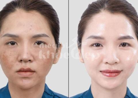 Trị nám hỗn hợp hiệu quả – Công nghệ chuẩn y khoa, cam kết an toàn - 3/4