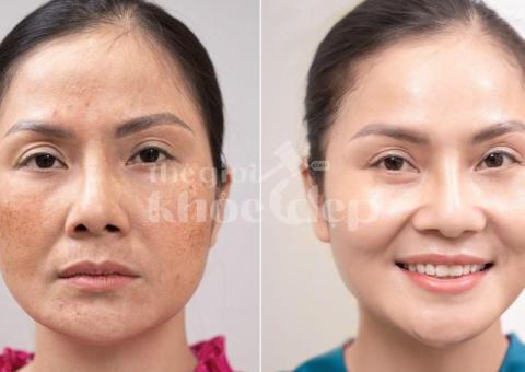 Trị nám chân sâu hiệu quả, an toàn – Giải pháp da sáng mịn bền lâu - 3/4