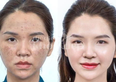 Trị nám chân sâu hiệu quả, an toàn – Giải pháp da sáng mịn bền lâu - 4/4