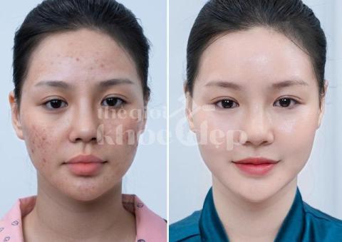 Trị nám hỗn hợp tận gốc – Công nghệ mới, an toàn, hiệu quả bền lâu - 1/6