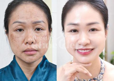 Trị nám hỗn hợp tận gốc – Công nghệ mới, an toàn, hiệu quả bền lâu - 2/6