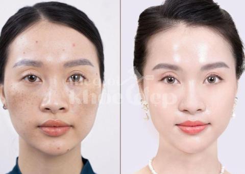 Trị nám hỗn hợp tận gốc – Công nghệ mới, an toàn, hiệu quả bền lâu - 3/6